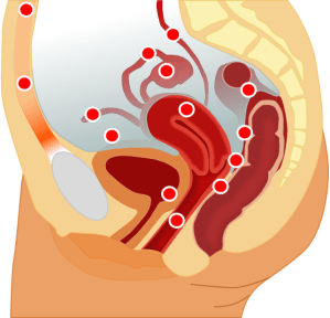 Common sites for endometriosis (en.wikipedia.org)