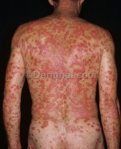 Psoriasis (www.dermnet.com)